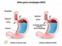 Régurgitations et Reflux Gastro Oesophagiens (RGO) du nourrisson par votre ostéopathe Elie KAHN à Nice.